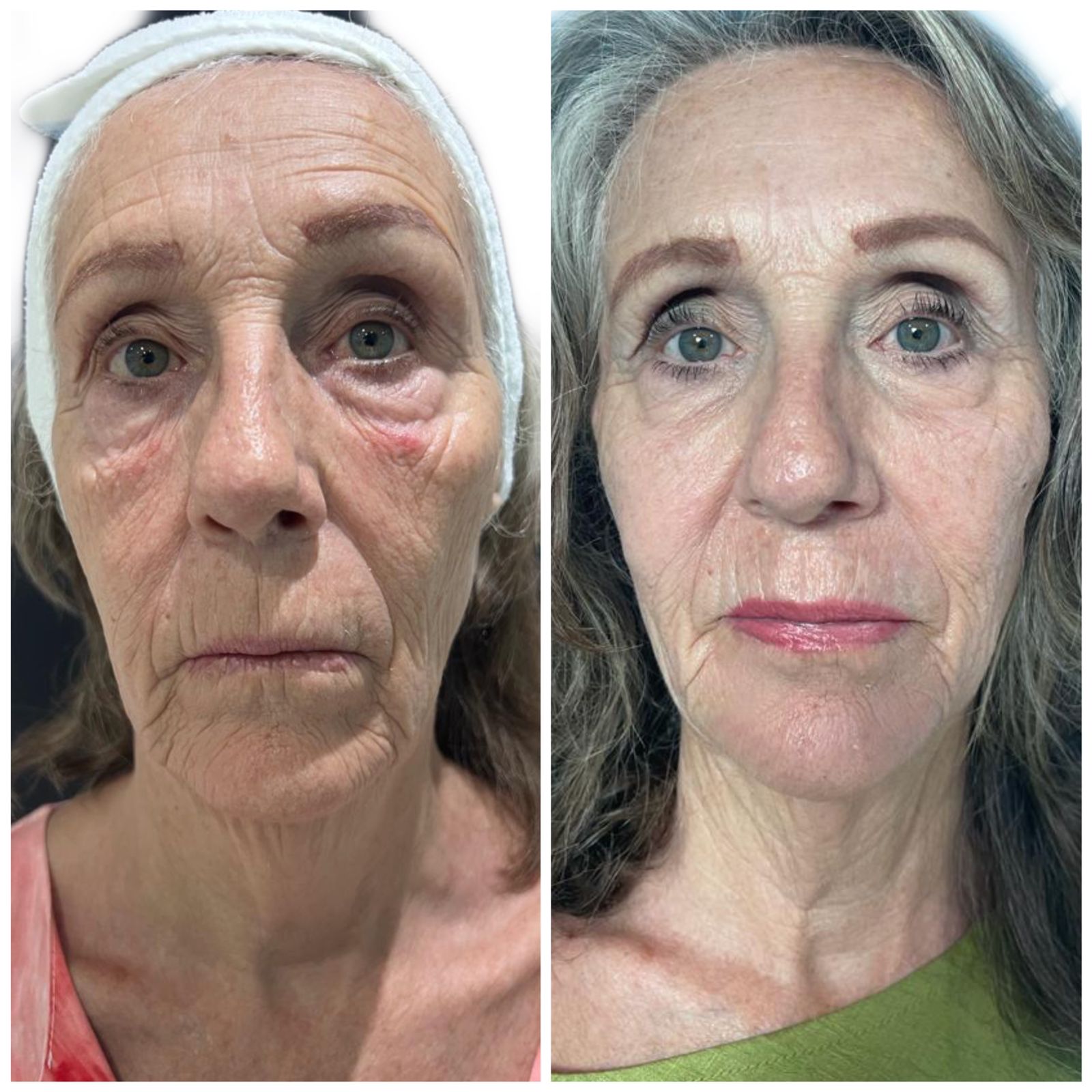 FOR FACE