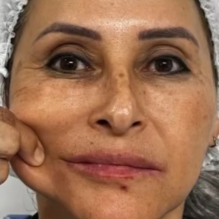 Antes: HArmonyCa, firmeza de la piel (prueba de pellizco)