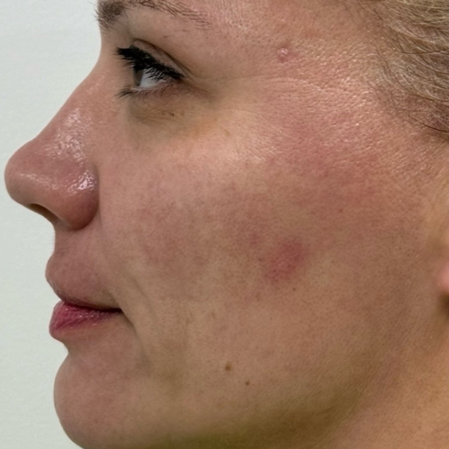 Antes: HArmonyCa + Sculptra, perfil izquierdo