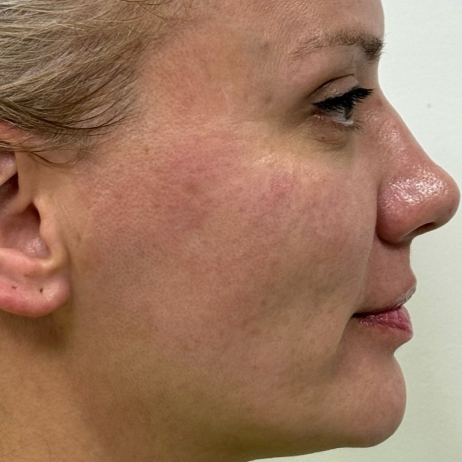 Antes: HArmonyCa + Sculptra, perfil derecho