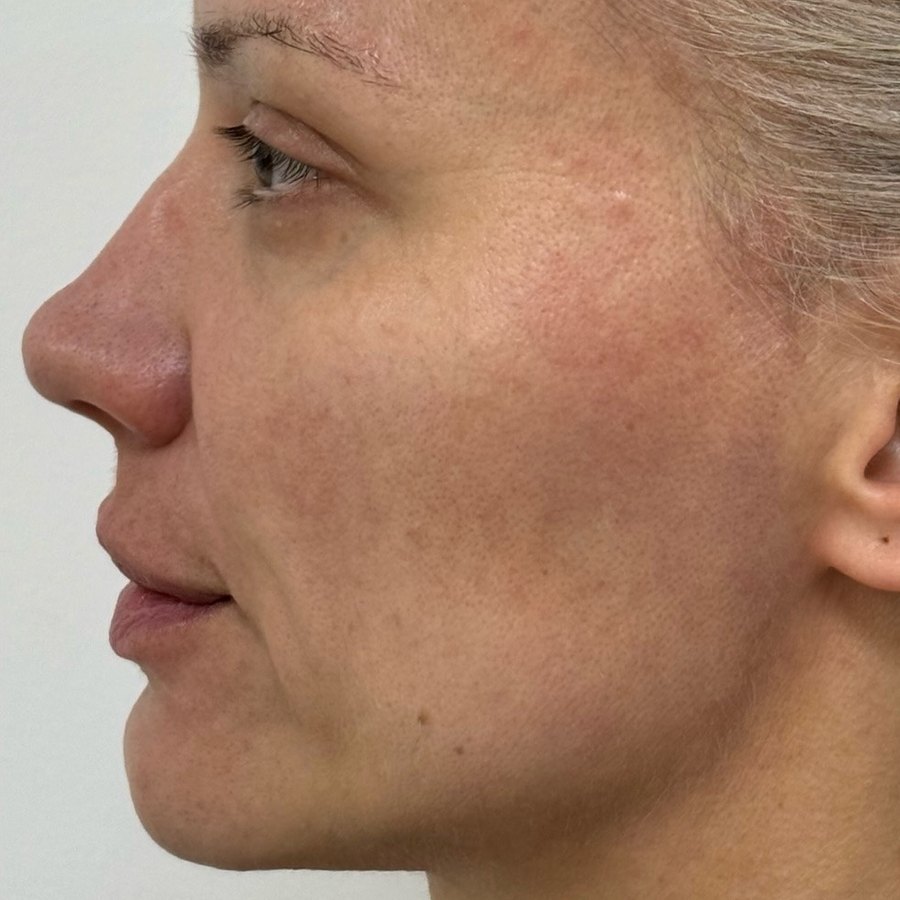 Después: HArmonyCa + Sculptra, perfil izquierdo