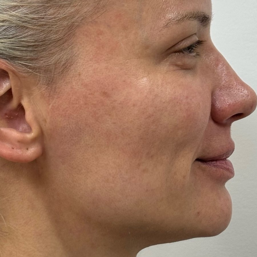 Después: HArmonyCa + Sculptra, perfil derecho