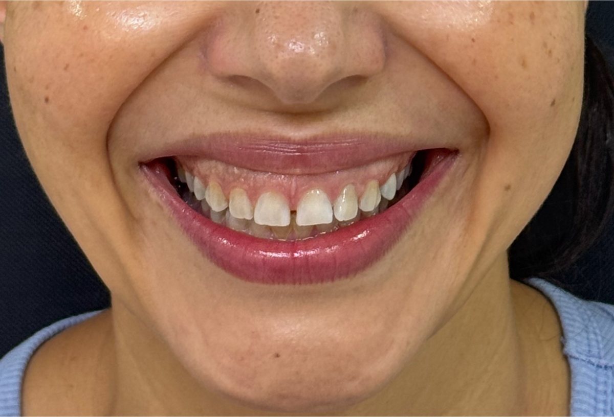 Antes: Botox, sonrisa gingival