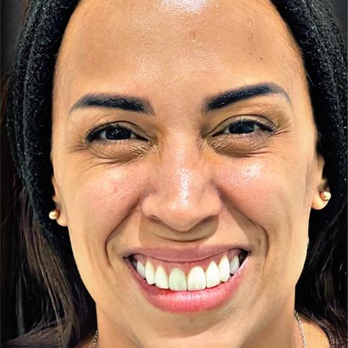 Before Botox, crow's feet and expression lines