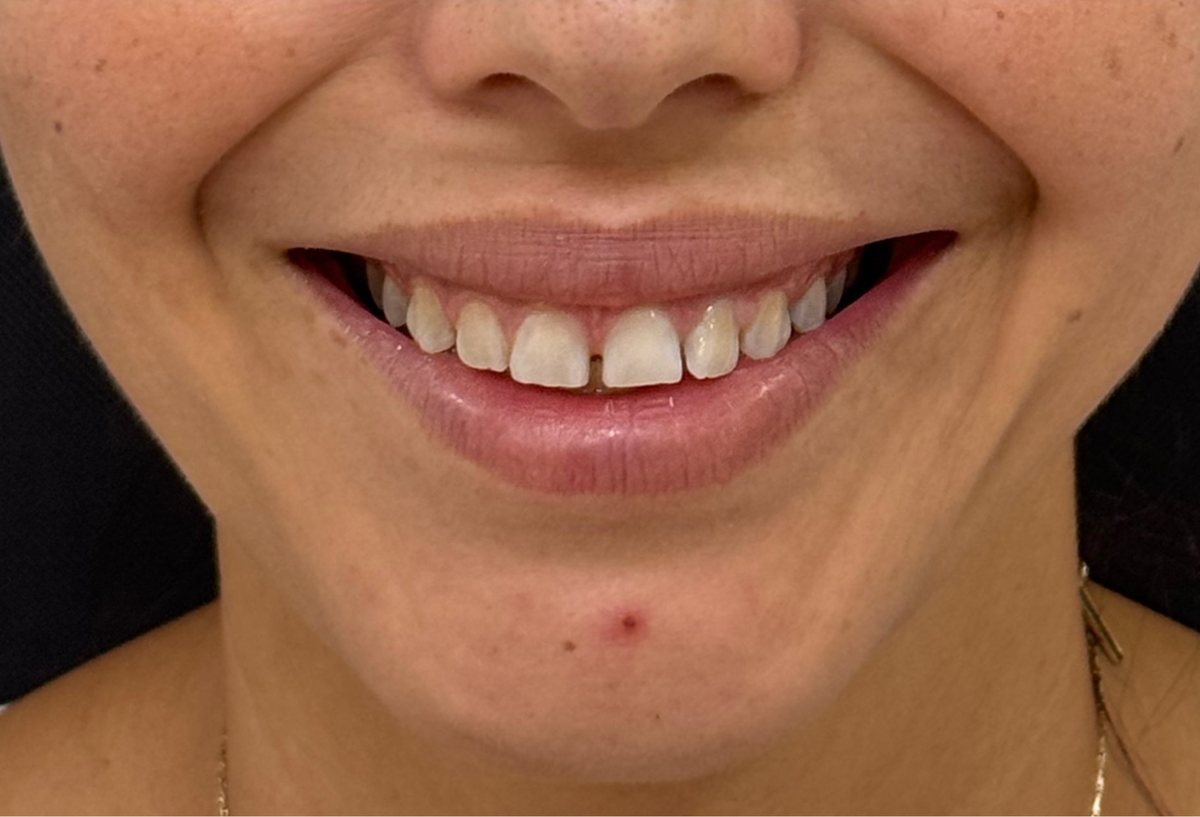 Después: Botox, sonrisa gingival