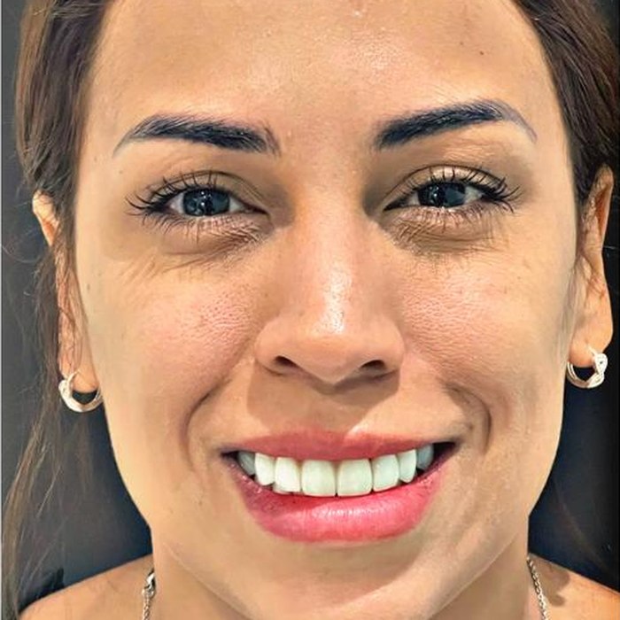 After Botox, crow's feet and expression lines