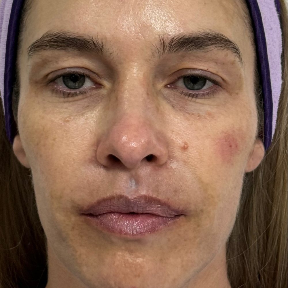 Before Facial harmonization with MD Codes