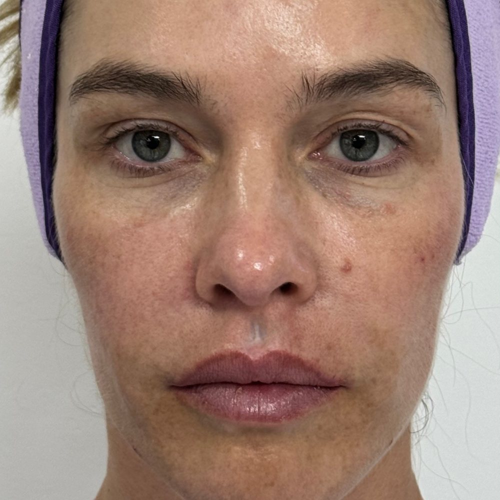 After Facial harmonization with MD Codes