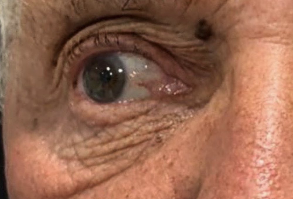 Before Nuvissa, upper and lower eyelids