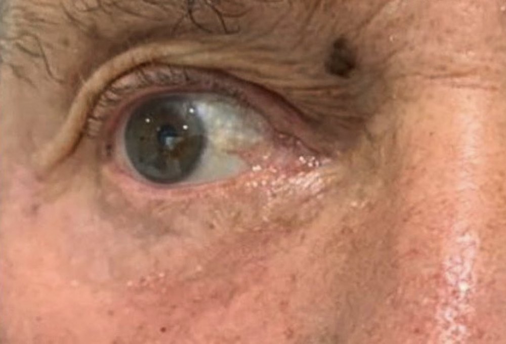 After Nuvissa, upper and lower eyelids